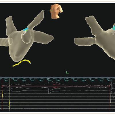 Figure 3 Illustration of the Vagal Response Induced by Radiofrequency Energy Delivery at the Left Superior Ganglionated Plexus with Sinus Arrest Lasting 2511 ms.
