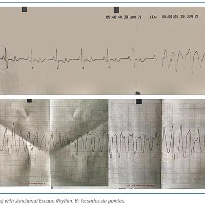 Figure 1 Electrocardiography During an Epileptic Episode