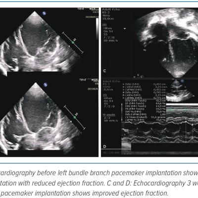 Figure 4 Echocardiography Before and After Left Bundle Branch Pacemaker Implantation