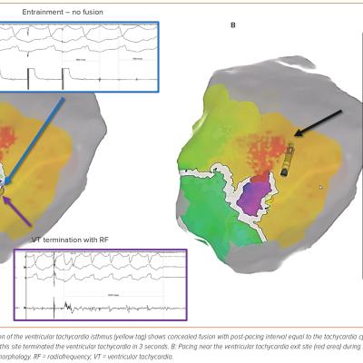 Figure 1 Entrainment and Pace-mapping of an Epicardial Ventricular Tachycardia