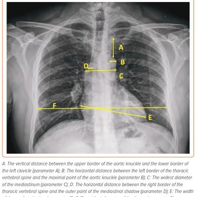 Figure 1 Radiographic Parameters on Chest X-Ray