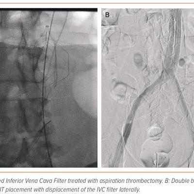 Figure 1 WALLSTENT Placement Following Thrombectomy of Acute Inferior Vena Cava Filter Occlusion