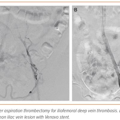 Figure 2 Venovo Placement Following Thrombectomy of Acute Iliofemoral Deep Venous Thrombosis