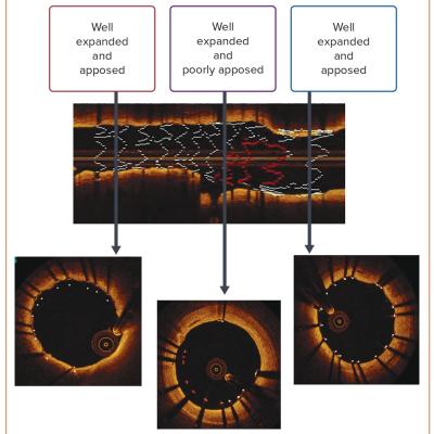Figure 3 Optical Coherence Images of Bifurcation Stenting in the Left Main