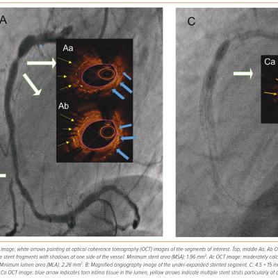 Figure 1 Diagnostic Angiographic and Optical Coherence Tomography Images of Under-expanded Stented Right Coronary Artery Segment and Failure of Conventional Balloon Angioplasty
