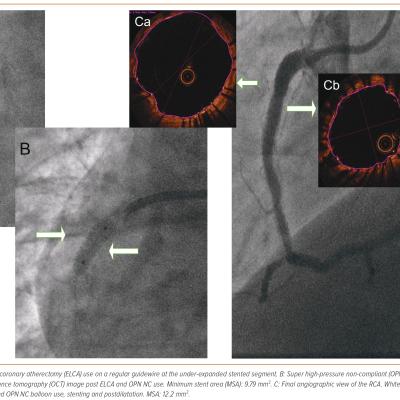 Figure 2 Angiographic and Optical Coherence Tomography Images of Laser Super High-pressure Non-compliant Balloon Successful Treatment