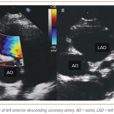 Figure 1 Colour Doppler Flow Mapping Showing There is No Coronary Artery Obstruction