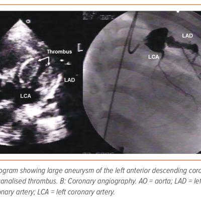 Figure 3 2D Echocardiogram and Coronary Angiography
