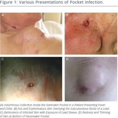 Various Presentations of Pocket Infection. 