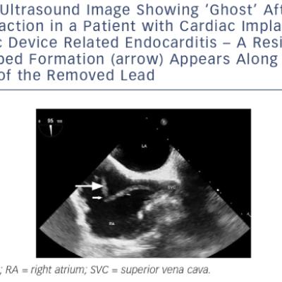 Ultrasound Image Showing ‘Ghost’ After Lead Extraction in a Patient with Cardiac Implantable Electronic Device Related Endocarditis – A Residual Tube-shaped Formation arrow Appears Along the Pathway of the Removed Lead