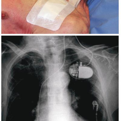 Photo and X-ray Illustrating Temporary Pacing in a Pacemaker-dependent Patient Using a Right Ventricular Screw-in Lead Introduced via the Left Internal Jugular Vein and Connected to a Re-use Pacemaker Taped on the Thorax
