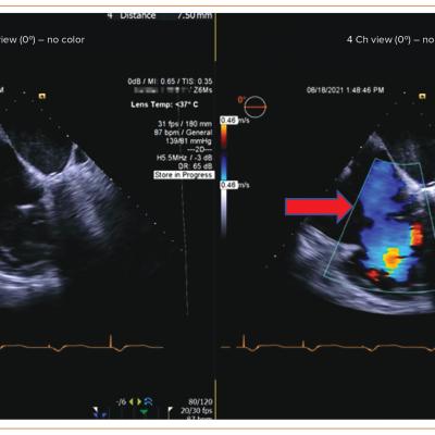 Figure 2 Mid Esophageal View of Transesophageal Echocardiogram Showing Severe Tricuspid Regurgitation