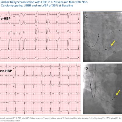 Cardiac Resynchronisation with HBP in a 79-year-old Man with Nonischaemic Cardiomyopathy LBBB and an LVEF of 35 at Baseline