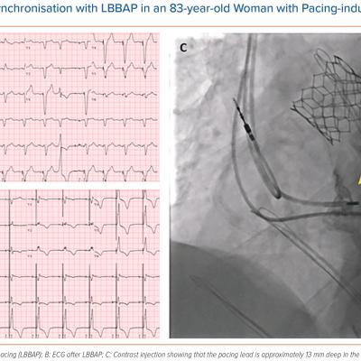 Cardiac Resynchronisation with LBBAP in an 83-year-old Woman with Pacing-induced Cardiomyopathy