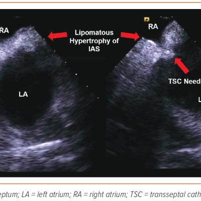 Figure 1 Lipomatous Hypertrophy of the Interatrial Septum