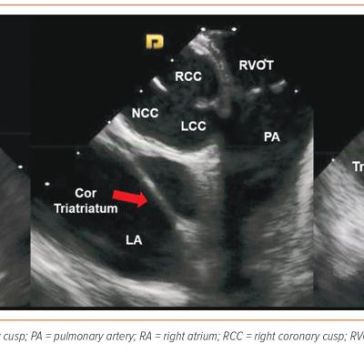 Figure 3 Transseptal Catheterisation for AF Ablation in a Patient with Cor Triatriatum