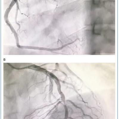 Figure 1 Result of Coronary Angiography in Case 1