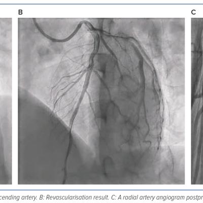 Figure 3 Result of Left Anterior Descending Artery Coronary Revascularisation in Case 1