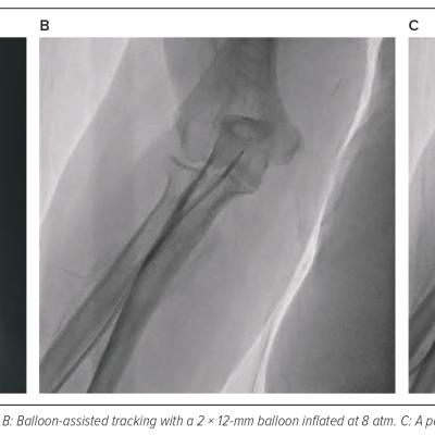 Figure 4 Balloon-assisted Tracking to Overcome Perforation in the Right Radial Artery in Case 2
