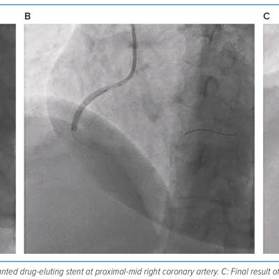 Figure 5 Final Result in Percutaneous Coronary Intervention Stenosis of the Right Coronary Artery in Case 2