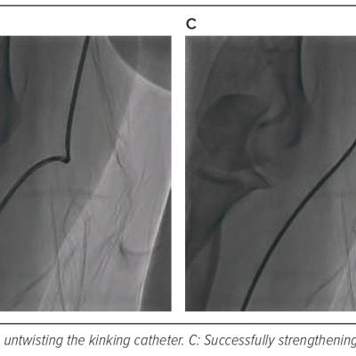 Figure 6 The Way to Overcome Catheter Kink in the Right Radial Artery in Case 3