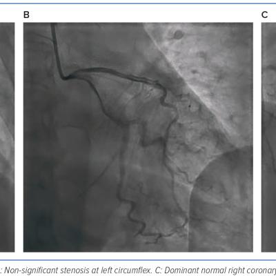 Figure 7 Coronary Angiography Results in Non-significant Coronary Artery Disease in Case 3