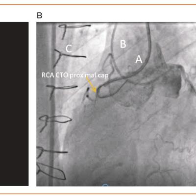 Figure 1 CT Coronary Angiography Prior to Attempted Chronic Total Occlusion Percutaneous Coronary Intervention in a Post-coronary Artery Bypass Graft Patient
