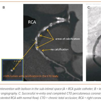 Figure 2 CT Coronary Angiography After Investment Procedure Facilitates Successful Stenting