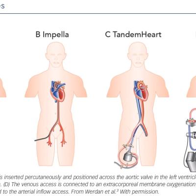  Percutaneous Assist Devices