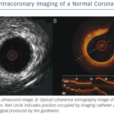 Intracoronary Imaging of a Normal Coronary Artery
