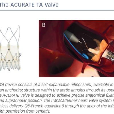 The ACURATE TA Valve