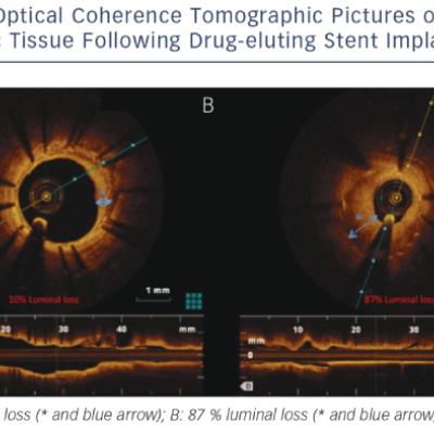 Optical Coherence Tomographic Pictures of Restenotic Tissue Following Drug-eluting Stent Implantation