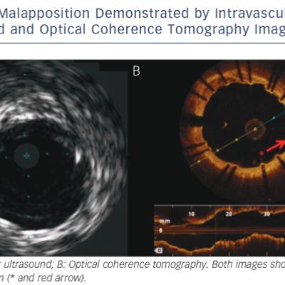  Malapposition Demonstrated by Intravascular Ultrasound and Optical Coherence Tomography Imaging