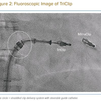 Fluoroscopic Image of TriClip