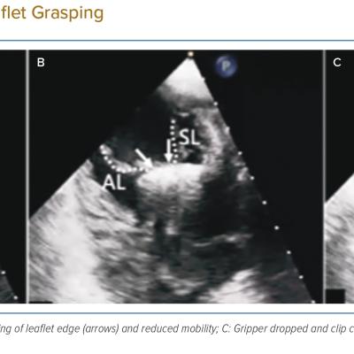 Transgastric View for Leaflet Grasping