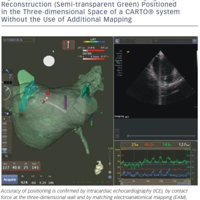 Three-dimensional Rotational Angiography Reconstruction Semi-transparent Green Positioned in the Three-dimensional Space of a CARTO® system Without the Use of Additional Mapping