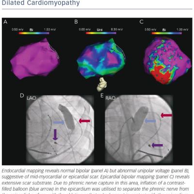 Electroanatomic Mapping in a Patient with Ventricular Tachycardia and Underlying Dilated Cardiomyopathy 