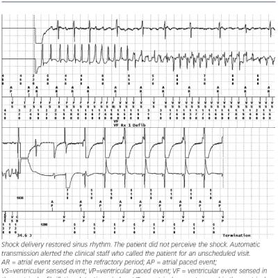  Ventricular Fibrillation Appropriately Detected and Treated at Night During Sleep 