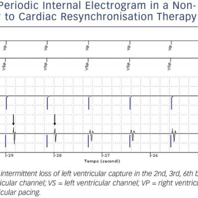 Periodic Internal Electrogram in a Nonresponder to Cardiac Resynchronisation Therapy
