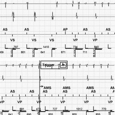  Alert for Newly Detected Atrial Fibrillation – Internal Atrial Electrogram Confirms Appropriate Detection