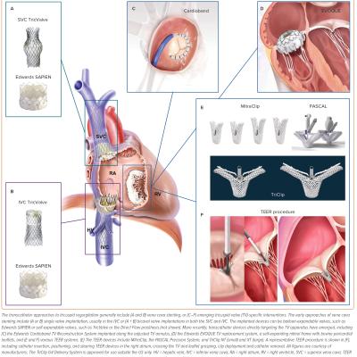 Figure 1 Devices for Percutaneous Tricuspid Regurgitation Therapy Classified by Anatomical Locations