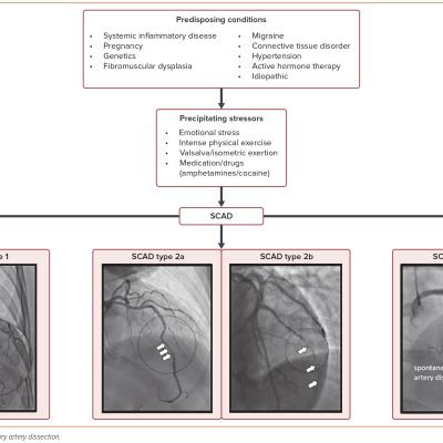 Figure 1 Predisposing Conditions and Stressors Leading to Spontaneous Coronary Artery Dissection with Angiographic Subtypes