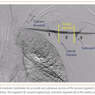 Figure 1 Percutaneous Axillary Artery Access