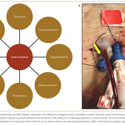 Figure 3 Pathophysiology and Prevention of Limb Ischemia in the Setting of Occlusive Large Bore Sheath