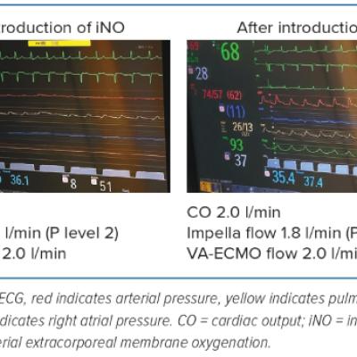 Figure 4 Monitoring Screens Before and After Inhaled Nitric Oxide Introduction Patient 1