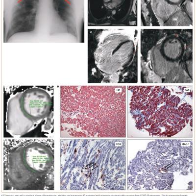 Figure 3 Post-acute Cardiovascular Sequelae of COVID-19 – Cardiovascular Disease