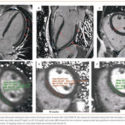 Figure 4 Myocardial Involvement in Post-acute Cardiovascular Sequelae of COVID-19 – Cardiovascular Syndrome