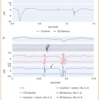 Figure 2 Differences in Visibility of Pacemaker Potential and Low-voltage Electrograms