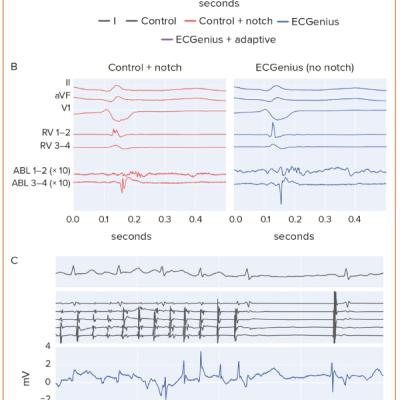 Figure 3 Preservation of Near-field Electrogram Information for Late Potentials and Arrhythmia Termination