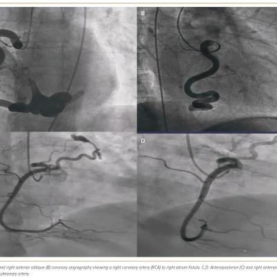 Figure 1 Examples of Coronary Artery Fistula
